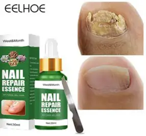 포진 연고 피부습진연고 곰팡이균 연고 발무좀약 피부 가려움 연고20g*1개 FDA 인가 S-06, 1개